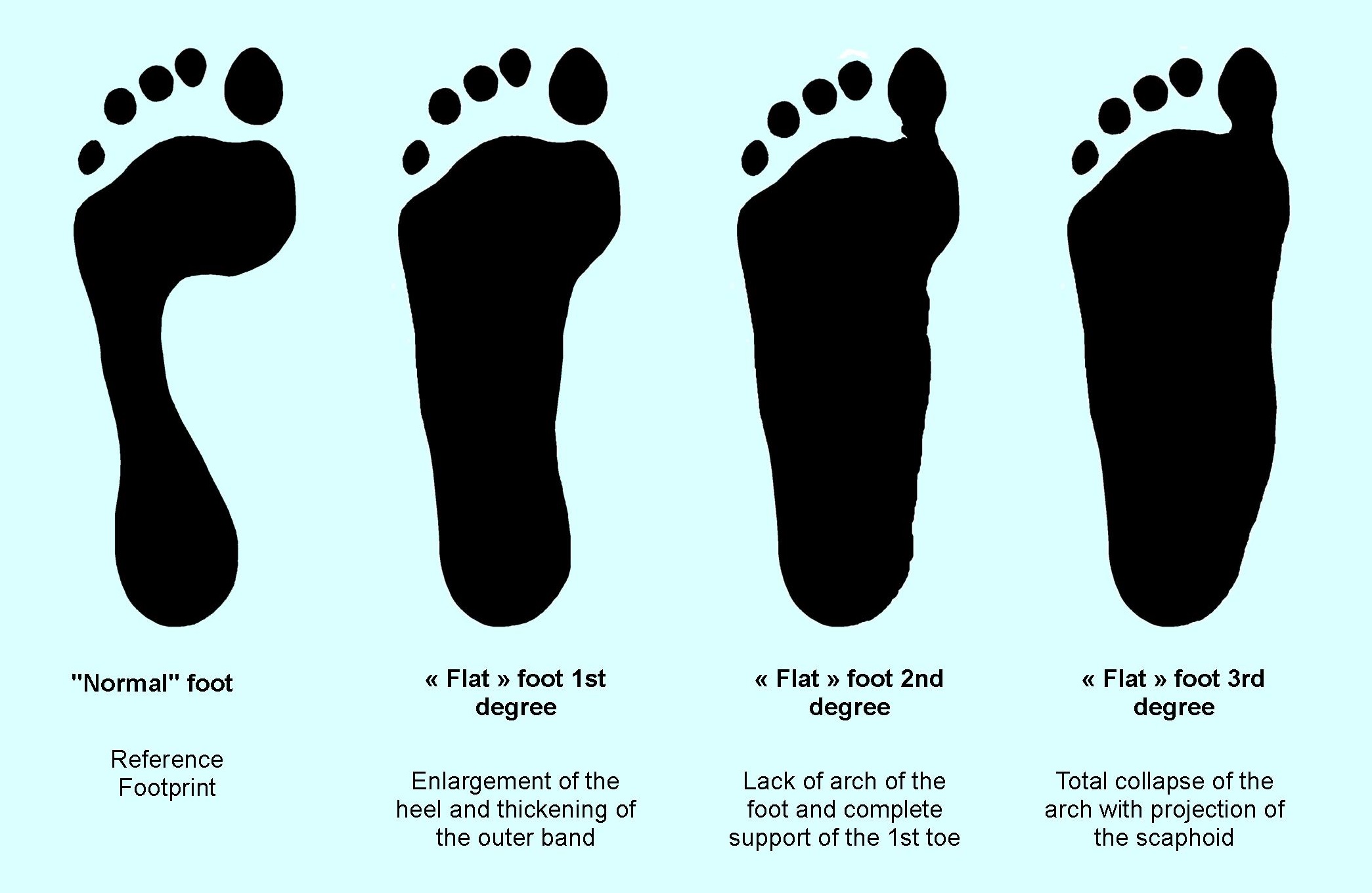 Moderate pronation clearance